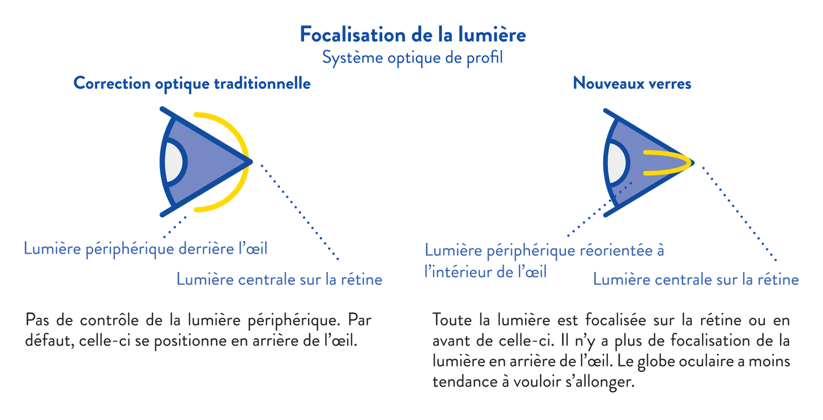 Schéma : avec une correction traditionnelle, la lumière périphérique se focalise derrière l'œil ; avec les nouveaux verres, toute la lumière est focalisée sur la rétine ou en avant