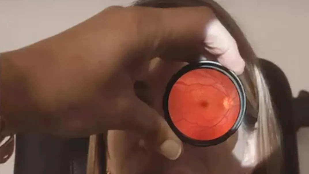Examen du fond d'œil à l'ophtalmoscope
