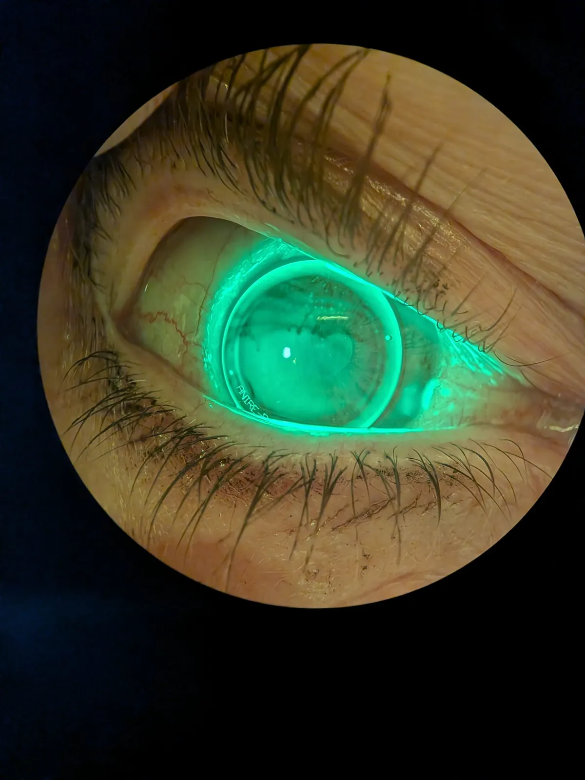 Lentille de nuit contrôlée à la lampe à fente avec de la fluorescéine