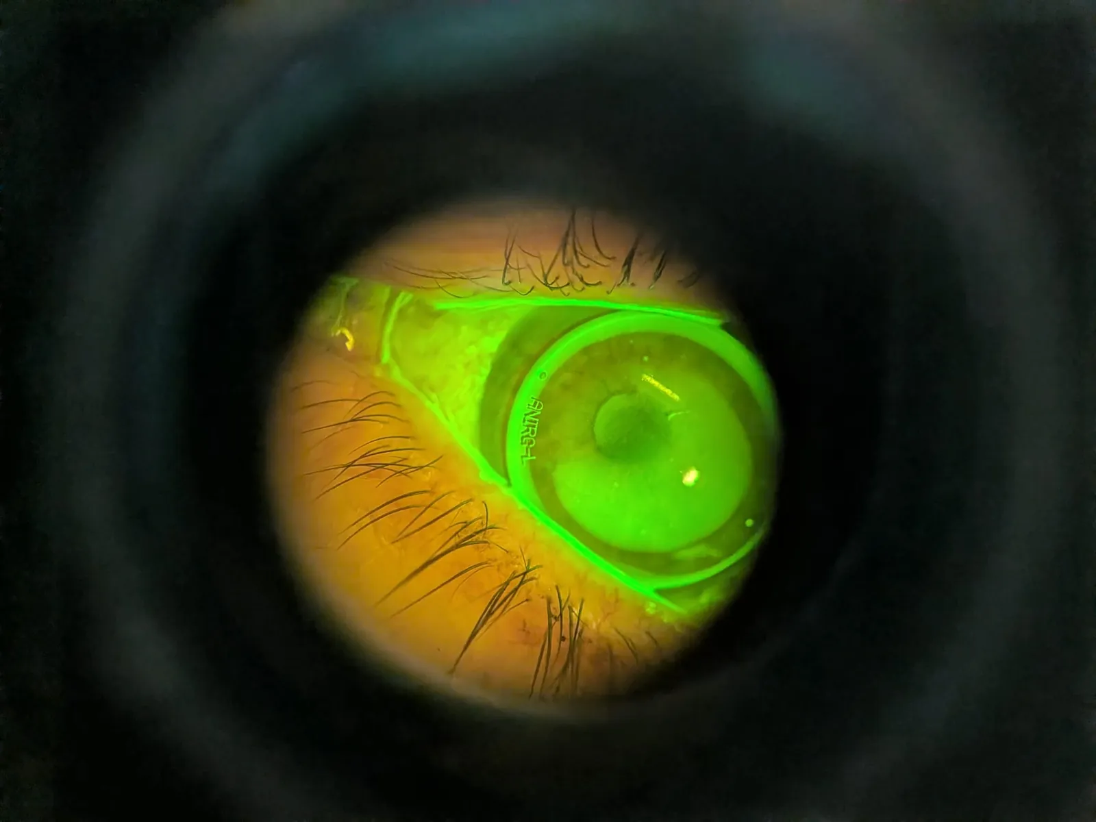 Lentille de nuit contrôlée à la fluorescéine