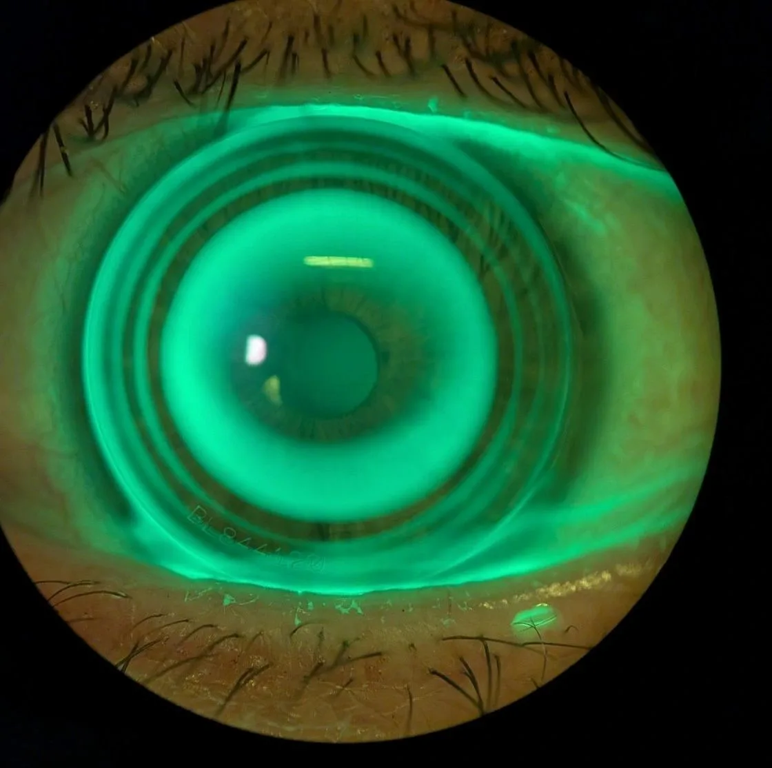 Lentille de nuit contrôlée à la fluorescéine
